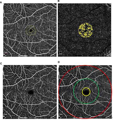 Inter-examiner and intra-examiner reliability of optical coherence tomography angiography in vascular density measurement of retinal and choriocapillaris plexuses in healthy children aged 6–15 years